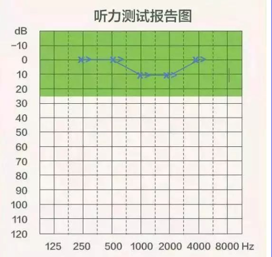 【聽(tīng)力科普】三分鐘看懂純音聽(tīng)力圖(圖10)