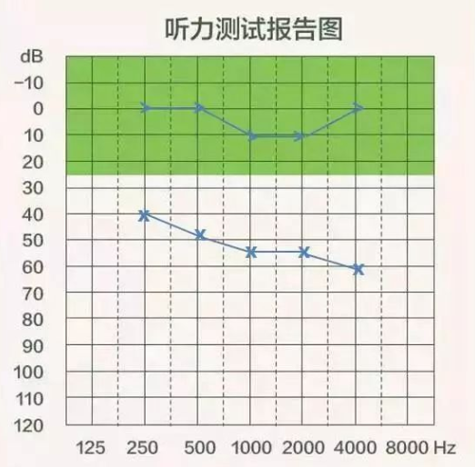 【聽(tīng)力科普】三分鐘看懂純音聽(tīng)力圖(圖11)