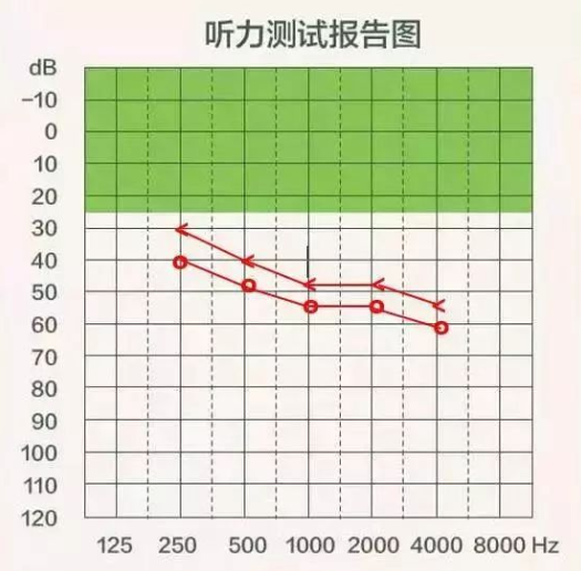 【聽(tīng)力科普】三分鐘看懂純音聽(tīng)力圖(圖12)